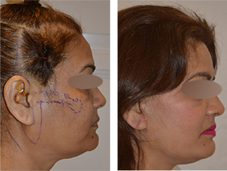 face-patient2